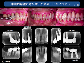 上越歯科医師会発表 ３完成.010-001.jpg